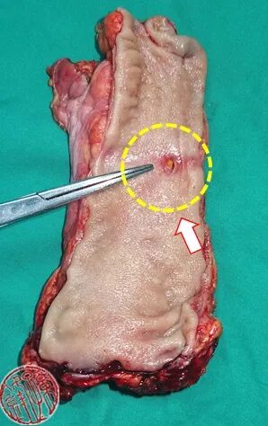 经典病例:腹膜外直肠损伤的影像学诊断_医学界-助力医生临床决策和