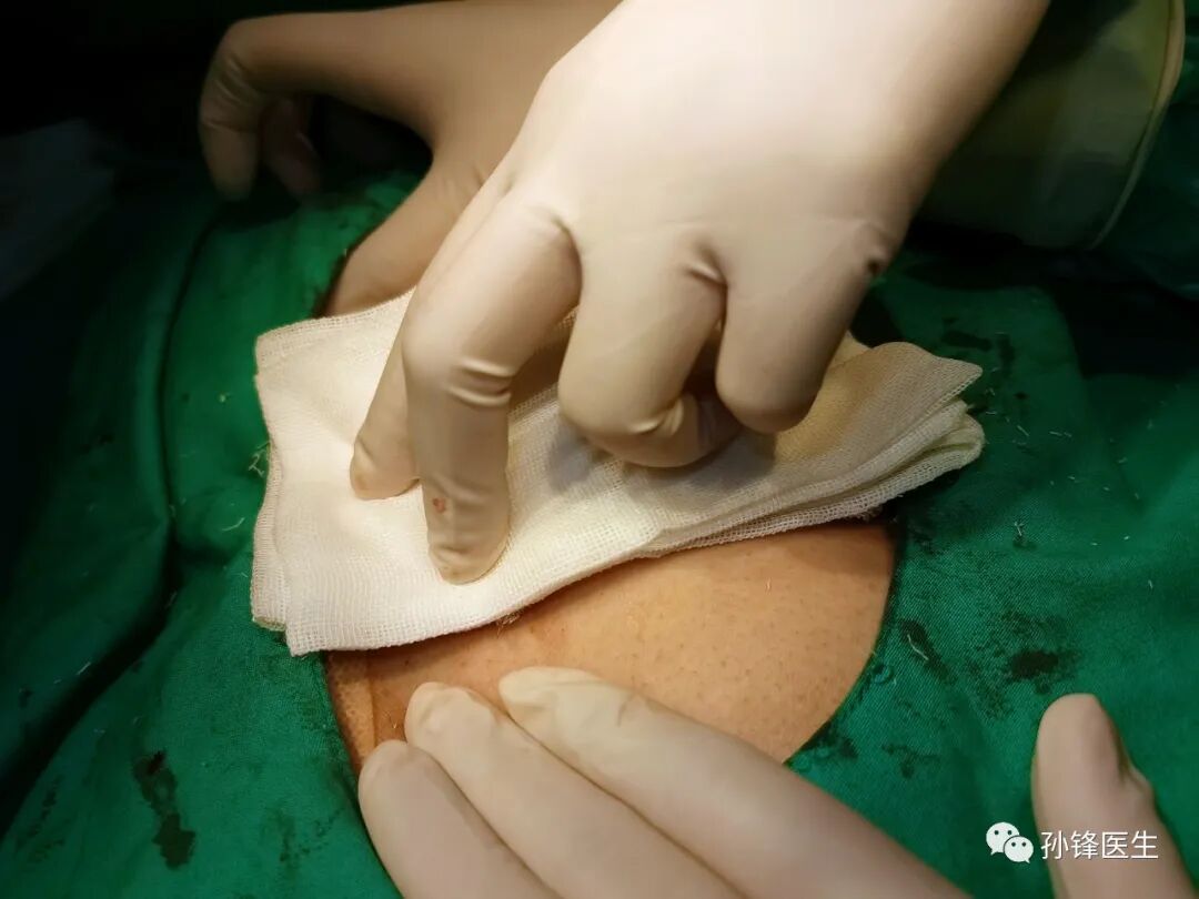 手把手教你:藏毛窦原位适形皮片移植术_医学界-助力医生临床决策和