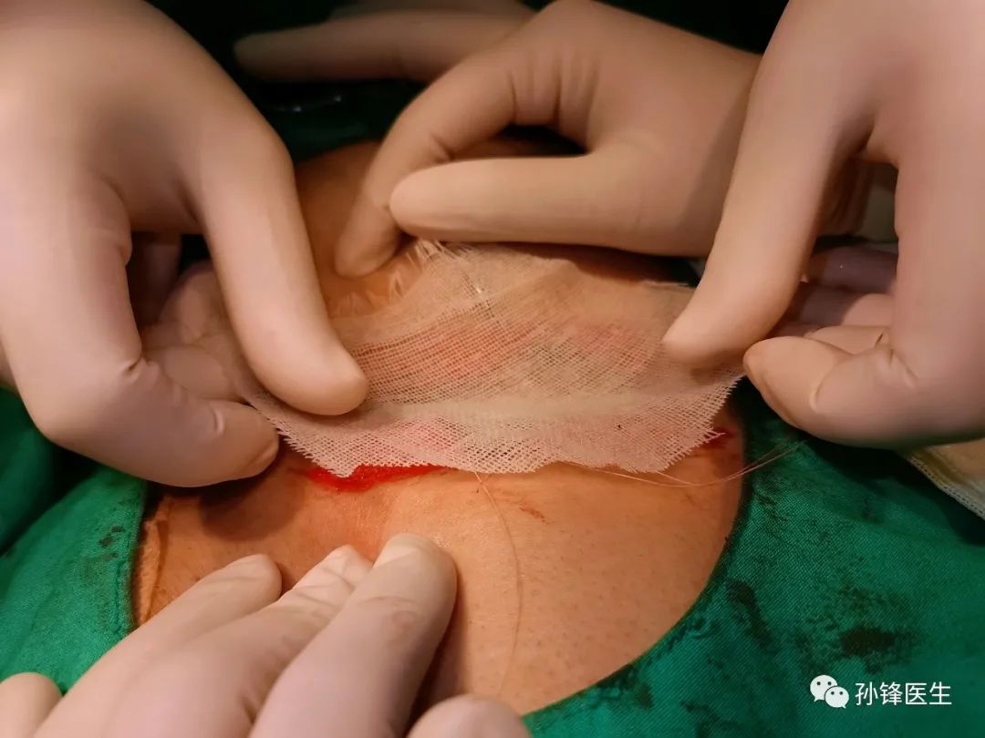 手把手教你:藏毛窦原位适形皮片移植术_医学界-助力医生临床决策和