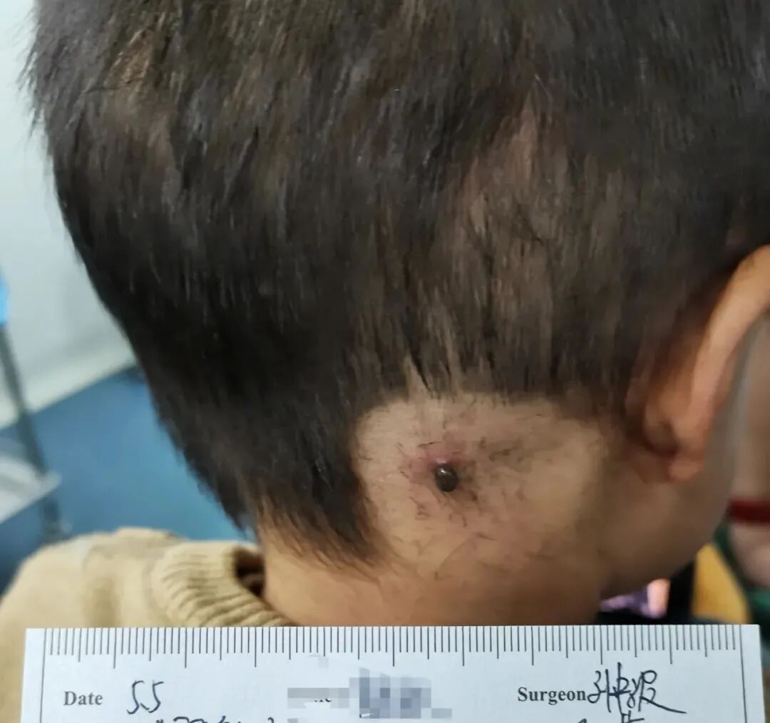 【提醒】2岁小孩被它吸血多天,涨大几十倍,取下来时还活着!