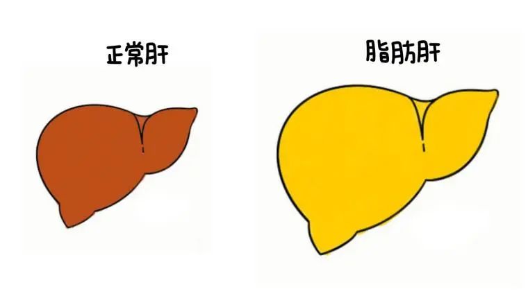 科学减重,享"瘦"生活丨我院开设"肥胖-脂肪肝"专病门诊