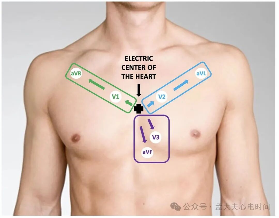 单导联ST段抬高的警报：aVL孤立抬高预示血管闭塞