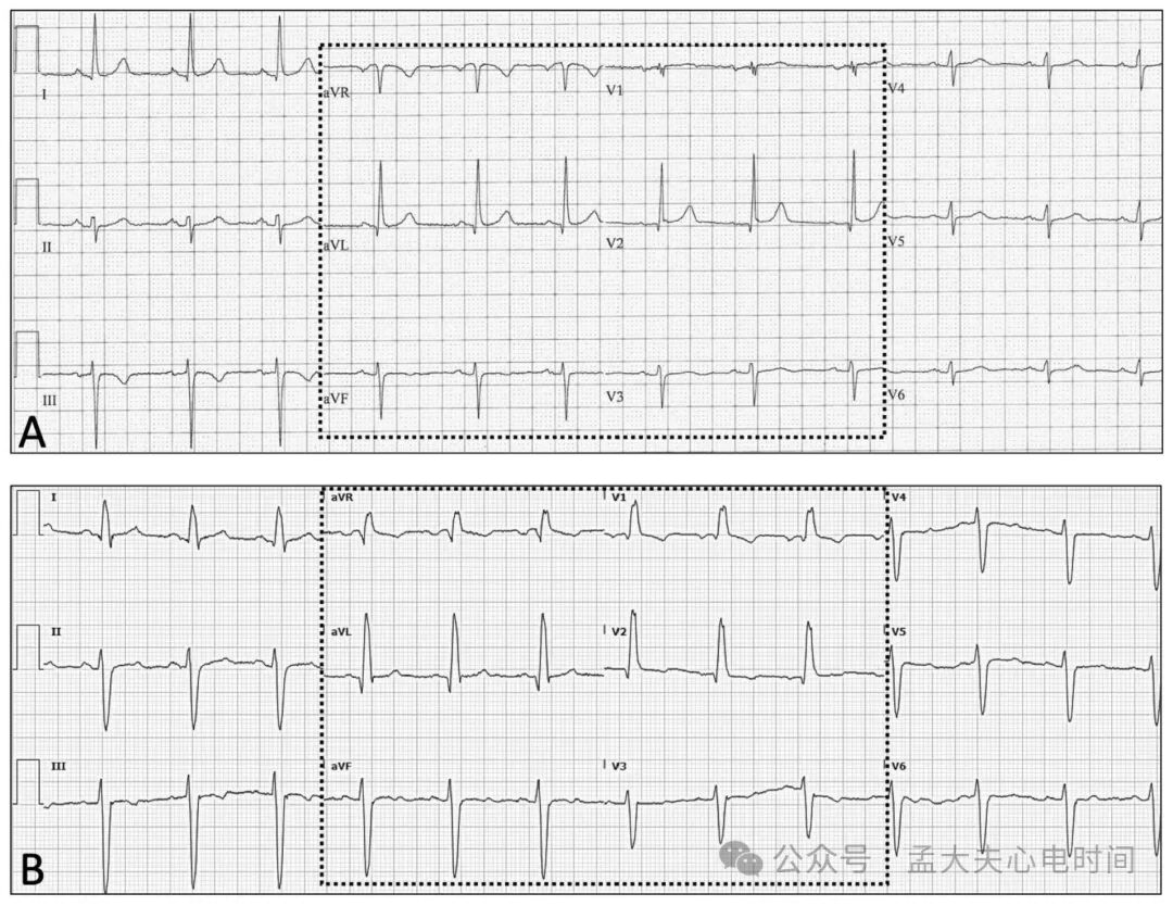 单导联ST段抬高的警报：aVL孤立抬高预示血管闭塞