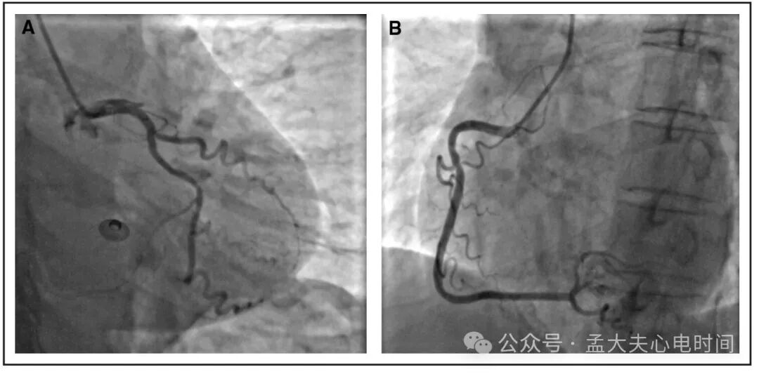 单导联ST段抬高的警报：aVL孤立抬高预示血管闭塞