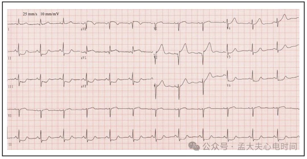 单导联ST段抬高的警报：aVL孤立抬高预示血管闭塞
