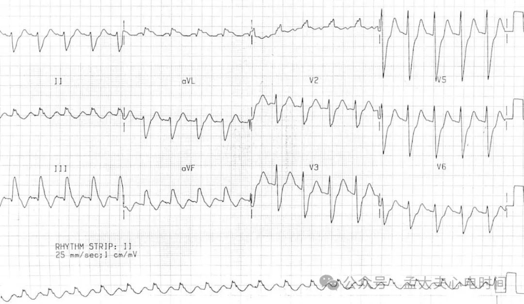 完全性右束支阻滞（CRBBB）的诊断标准