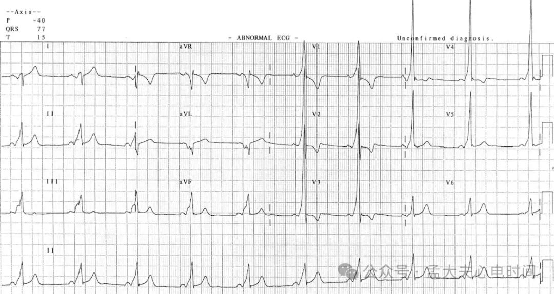 完全性右束支阻滞（CRBBB）的诊断标准