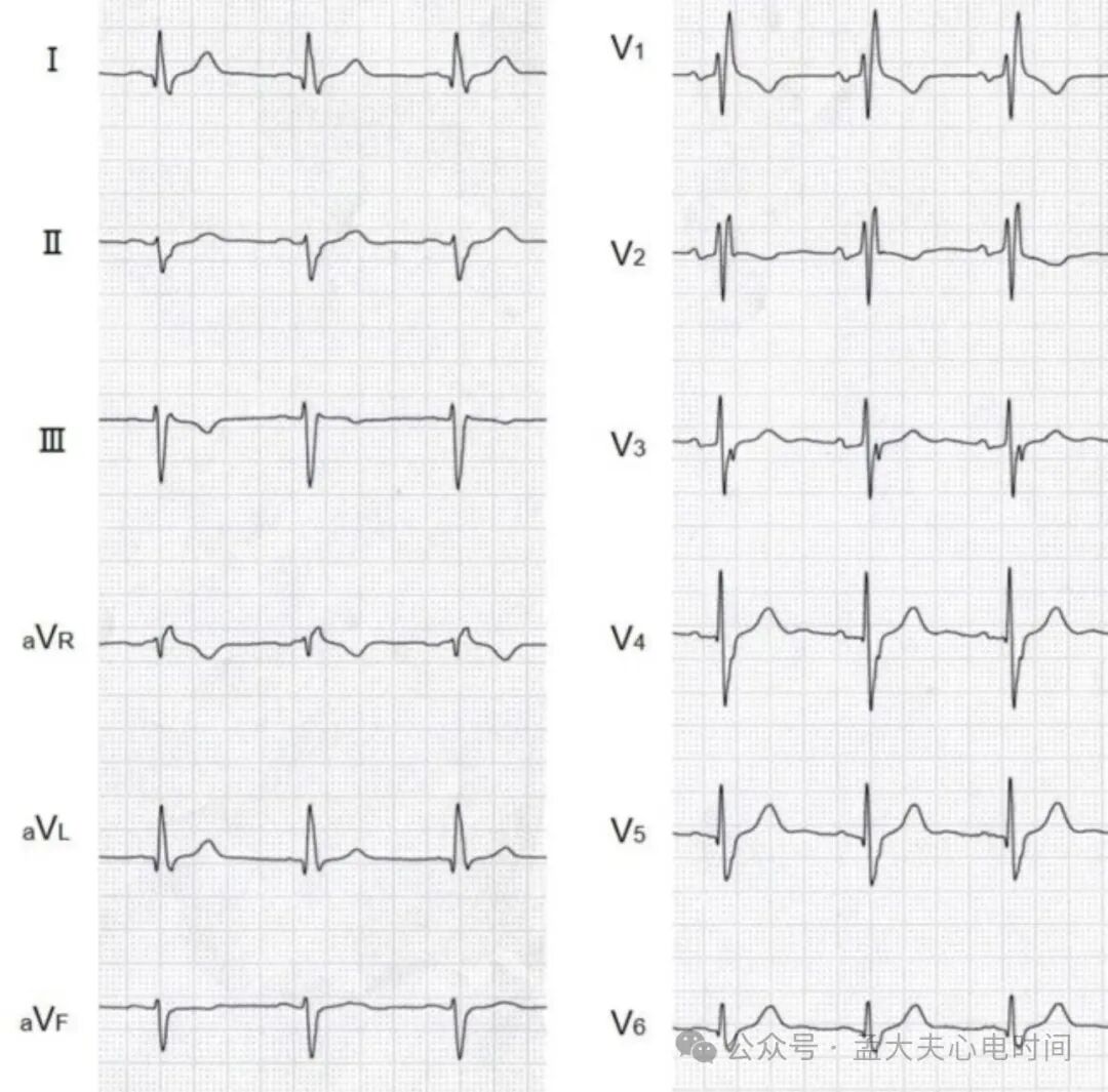 完全性右束支阻滞（CRBBB）的诊断标准