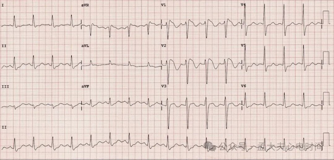 完全性右束支阻滞（CRBBB）的诊断标准