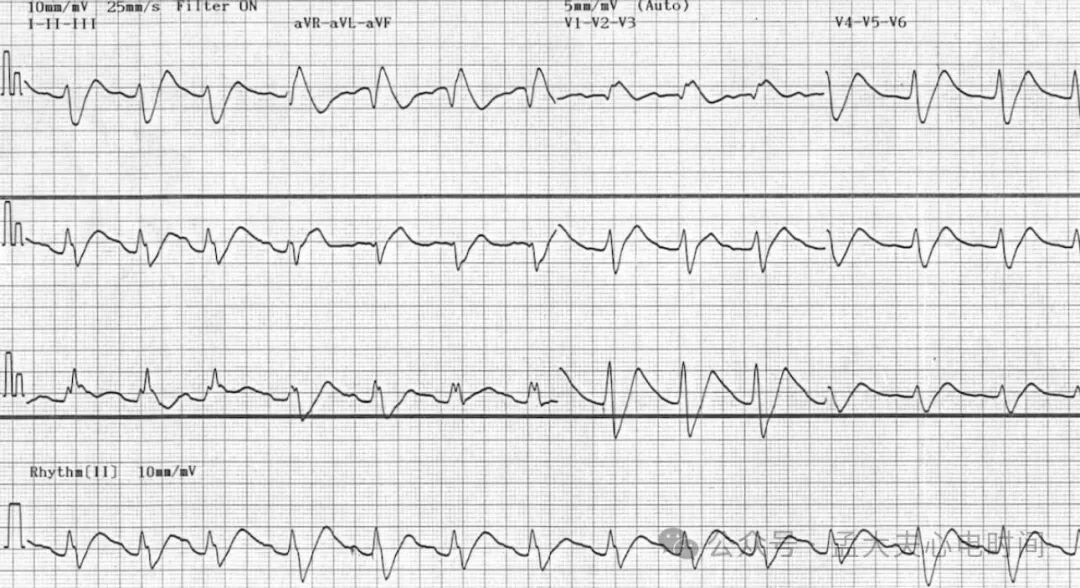 完全性右束支阻滞（CRBBB）的诊断标准