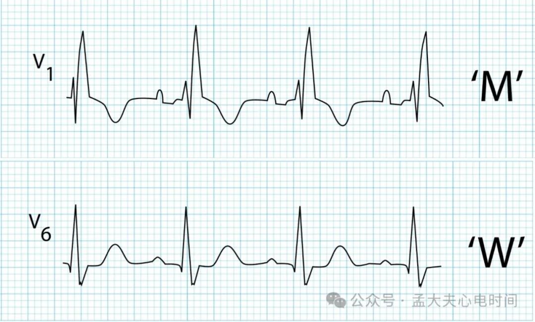 完全性右束支阻滞（CRBBB）的诊断标准