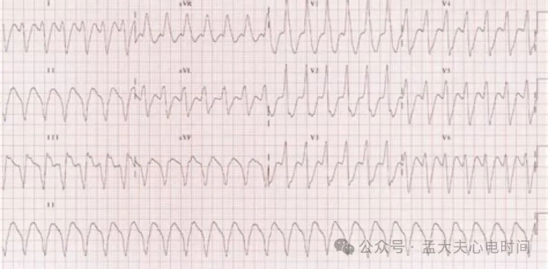完全性右束支阻滞（CRBBB）的诊断标准