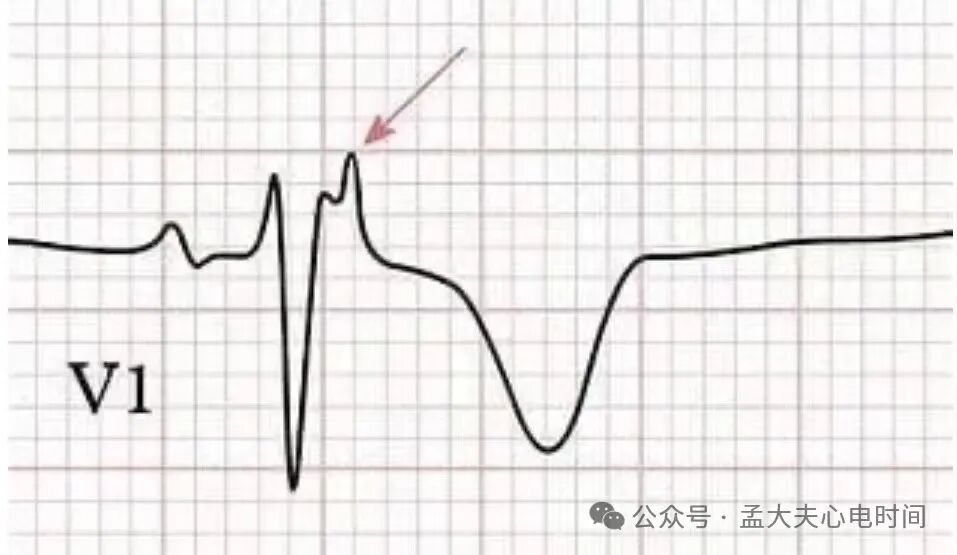 凯进心电图怎么打记忆7种不容错过的高危晕厥心电图特征-- “ABCDE Left Right”记忆法_https://www.jmylbn.com_新闻资讯_第8张
