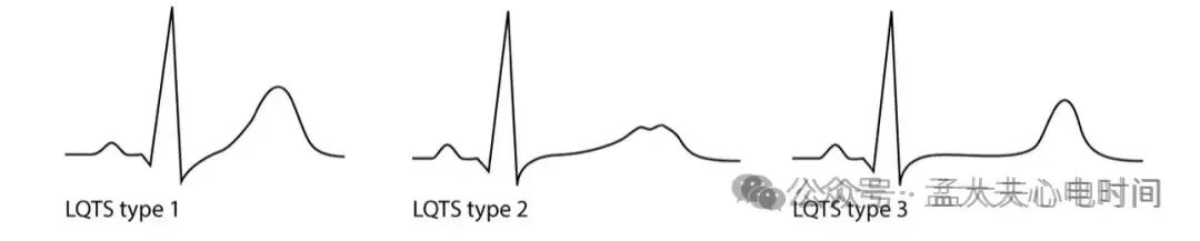 凯进心电图怎么打记忆7种不容错过的高危晕厥心电图特征-- “ABCDE Left Right”记忆法_https://www.jmylbn.com_新闻资讯_第6张