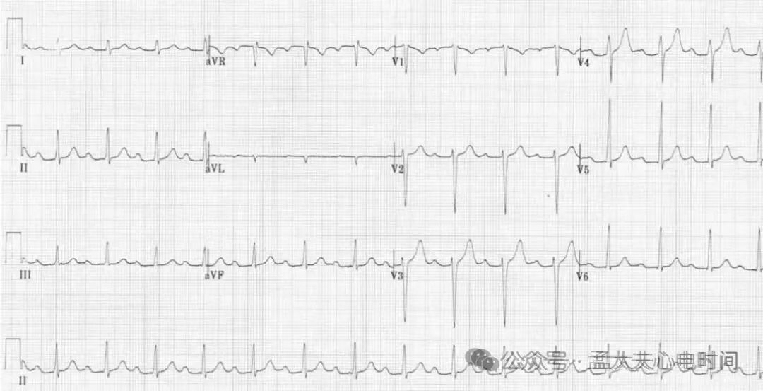 凯进心电图怎么打记忆7种不容错过的高危晕厥心电图特征-- “ABCDE Left Right”记忆法_https://www.jmylbn.com_新闻资讯_第2张