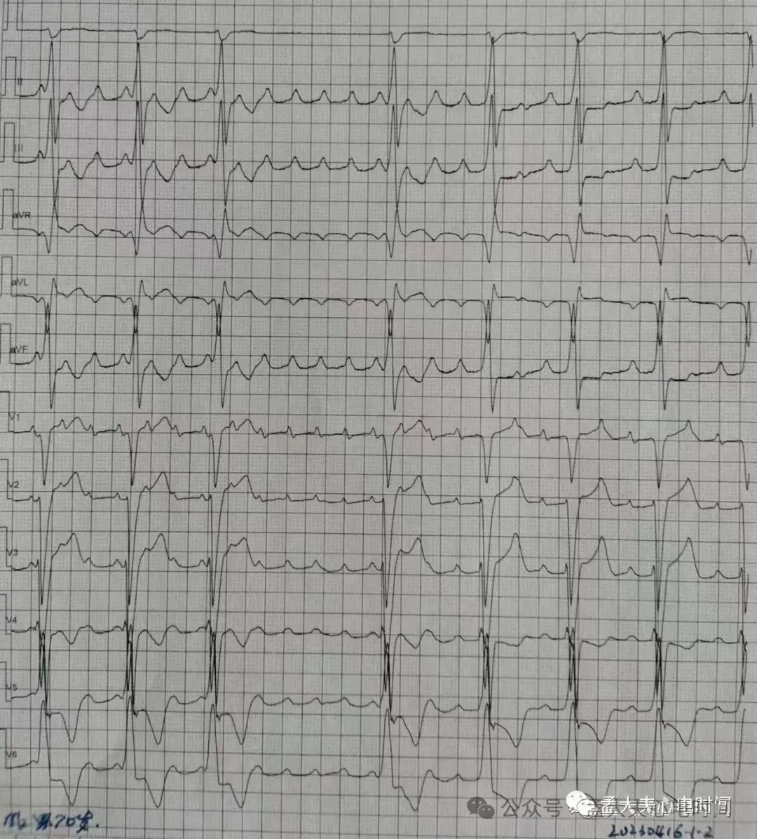 凯进心电图怎么打记忆7种不容错过的高危晕厥心电图特征-- “ABCDE Left Right”记忆法_https://www.jmylbn.com_新闻资讯_第9张
