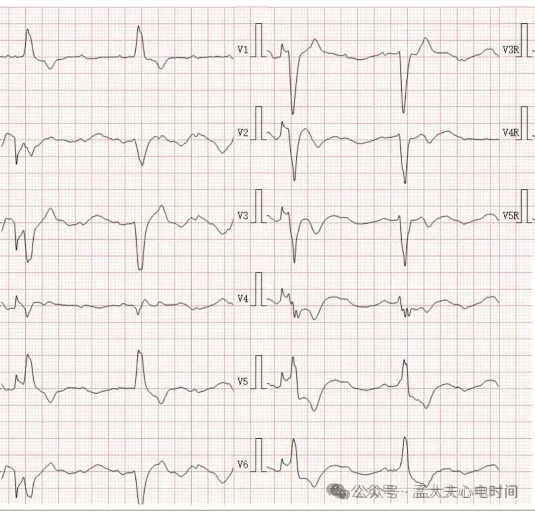 凯进心电图怎么打记忆7种不容错过的高危晕厥心电图特征-- “ABCDE Left Right”记忆法_https://www.jmylbn.com_新闻资讯_第4张