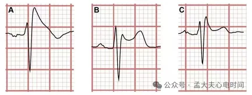 凯进心电图怎么打记忆7种不容错过的高危晕厥心电图特征-- “ABCDE Left Right”记忆法_https://www.jmylbn.com_新闻资讯_第5张