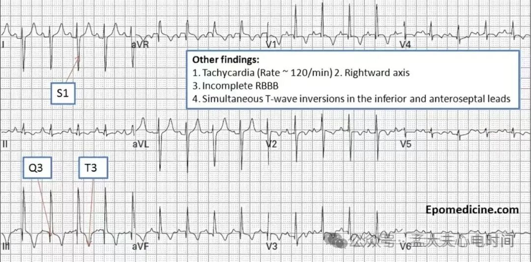 凯进心电图怎么打记忆7种不容错过的高危晕厥心电图特征-- “ABCDE Left Right”记忆法_https://www.jmylbn.com_新闻资讯_第10张