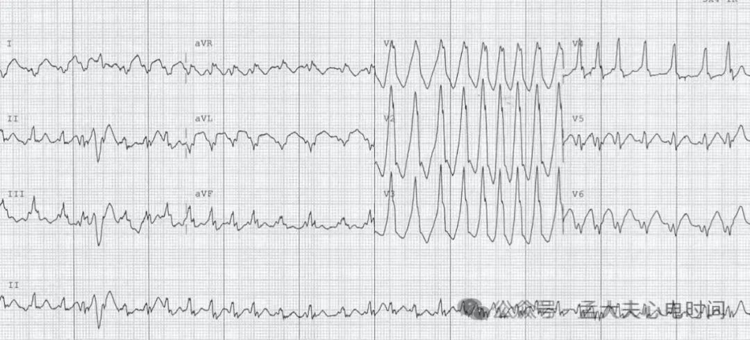 凯进心电图怎么打记忆7种不容错过的高危晕厥心电图特征-- “ABCDE Left Right”记忆法_https://www.jmylbn.com_新闻资讯_第7张