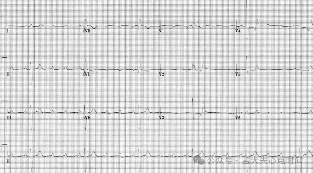 高度房室阻滞的心电图诊断