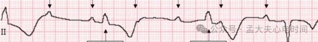 高度房室阻滞的心电图诊断