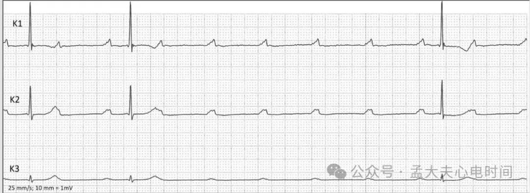 高度房室阻滞的心电图诊断