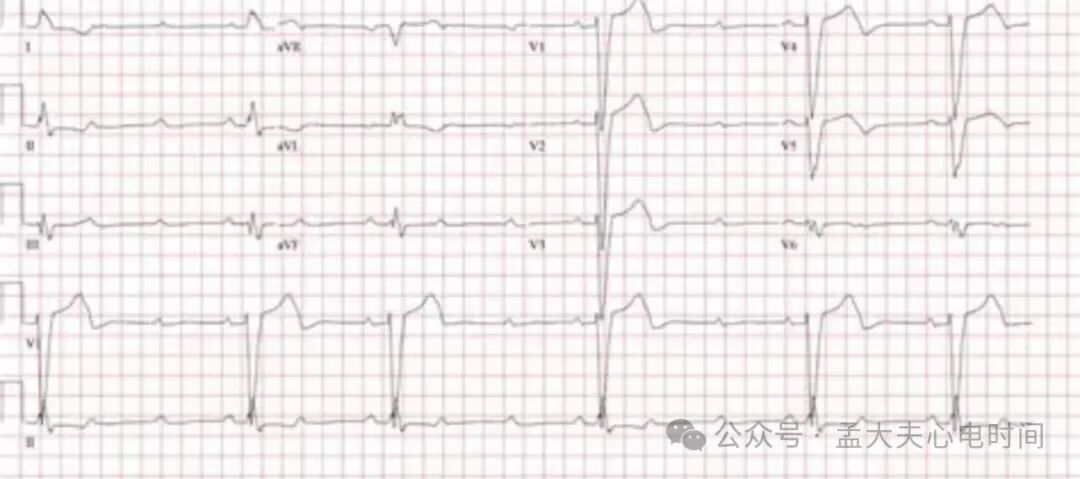 高度房室阻滞的心电图诊断