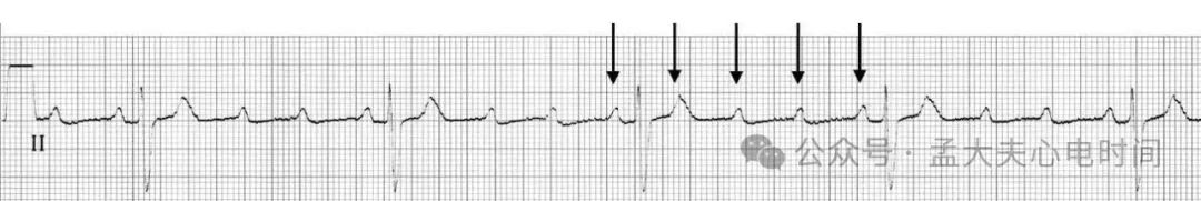 高度房室阻滞的心电图诊断