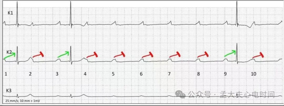 高度房室阻滞的心电图诊断