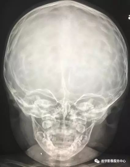 婴儿头部x光片图片