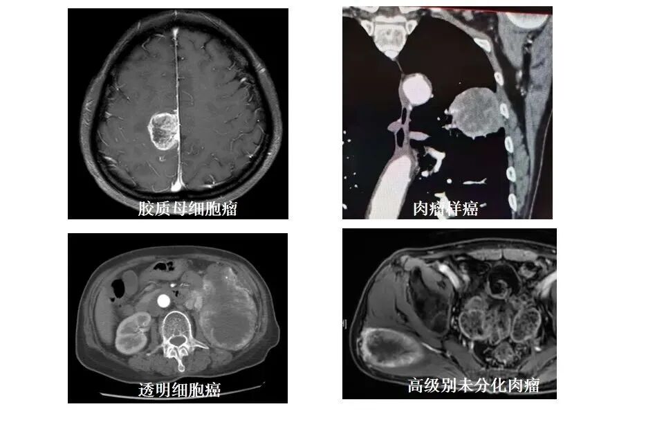怎么买病理图文这些影像征象背后的病理基础，今天才知道！_https://www.jmylbn.com_新闻资讯_第9张