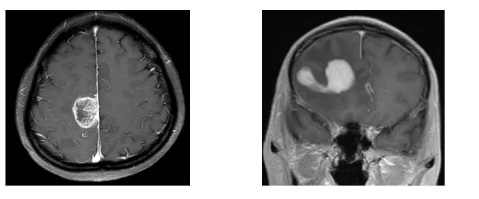 怎么买病理图文这些影像征象背后的病理基础，今天才知道！_https://www.jmylbn.com_新闻资讯_第2张