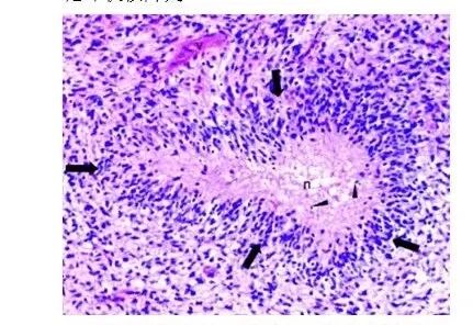 怎么买病理图文这些影像征象背后的病理基础，今天才知道！_https://www.jmylbn.com_新闻资讯_第5张