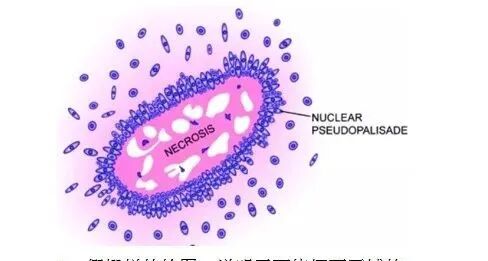 怎么买病理图文这些影像征象背后的病理基础，今天才知道！_https://www.jmylbn.com_新闻资讯_第4张