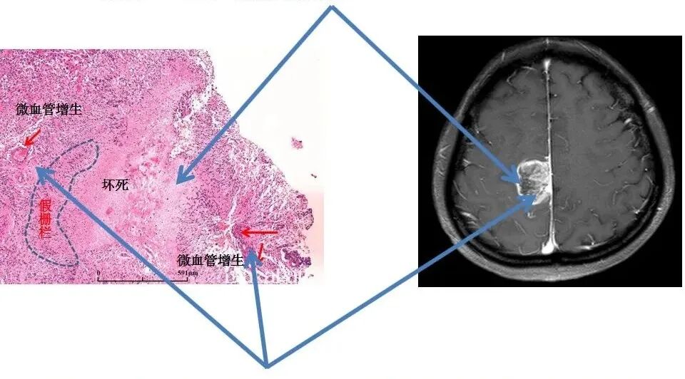 怎么买病理图文这些影像征象背后的病理基础，今天才知道！_https://www.jmylbn.com_新闻资讯_第7张