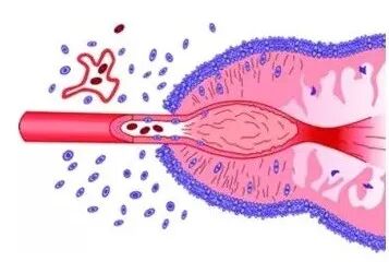 怎么买病理图文这些影像征象背后的病理基础，今天才知道！_https://www.jmylbn.com_新闻资讯_第6张