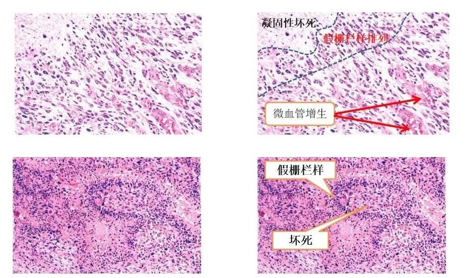 怎么买病理图文这些影像征象背后的病理基础，今天才知道！_https://www.jmylbn.com_新闻资讯_第3张
