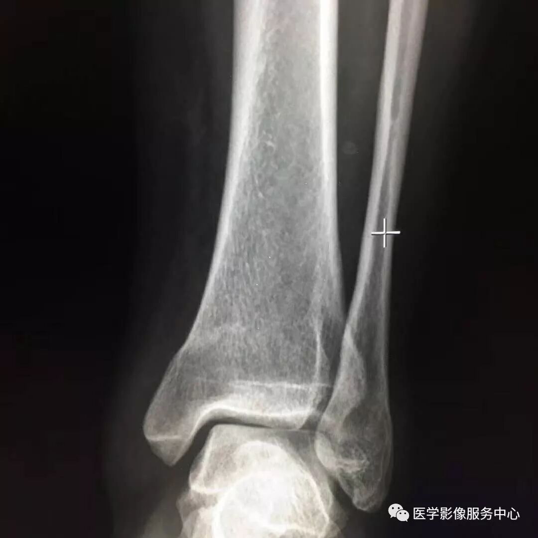 一例看不见骨折透亮线的骨折，新手估计会漏诊