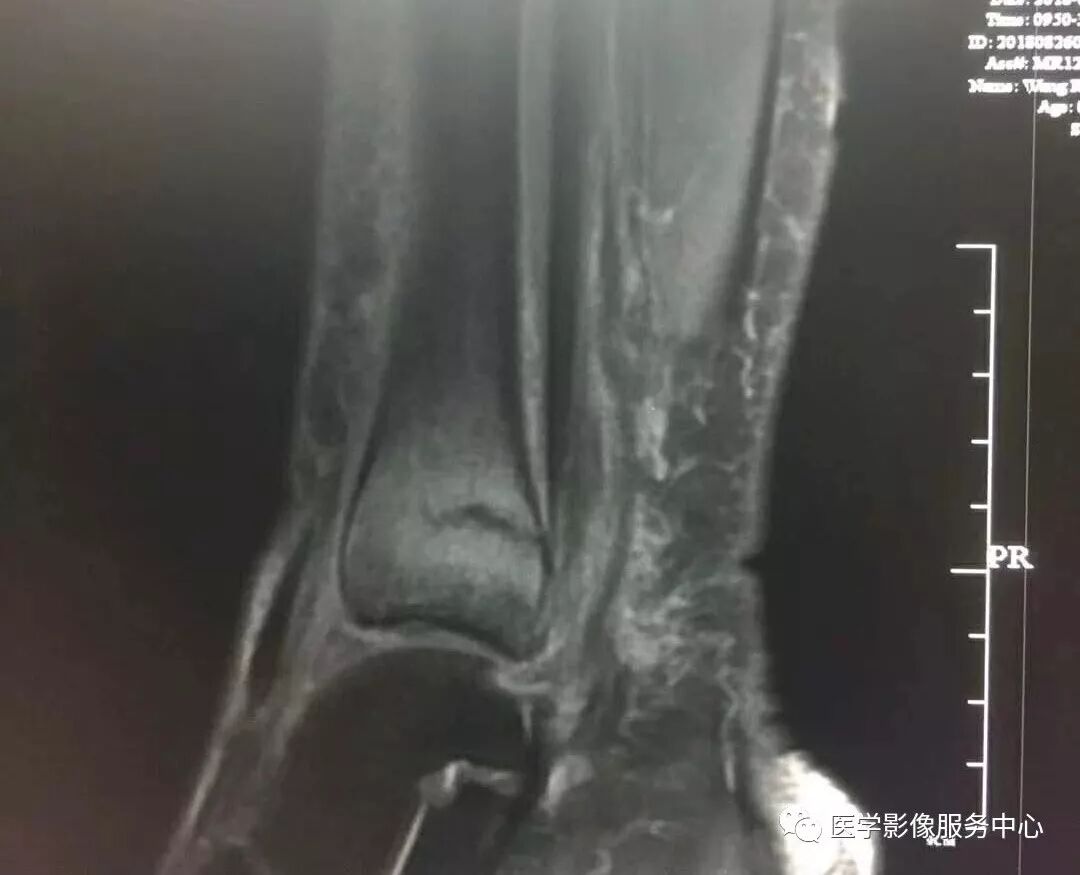 一例看不见骨折透亮线的骨折，新手估计会漏诊