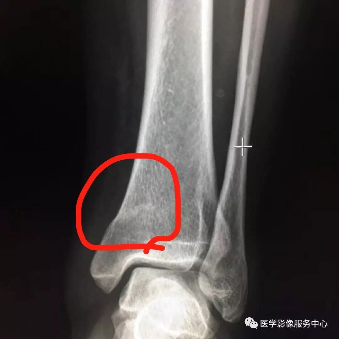一例看不见骨折透亮线的骨折，新手估计会漏诊