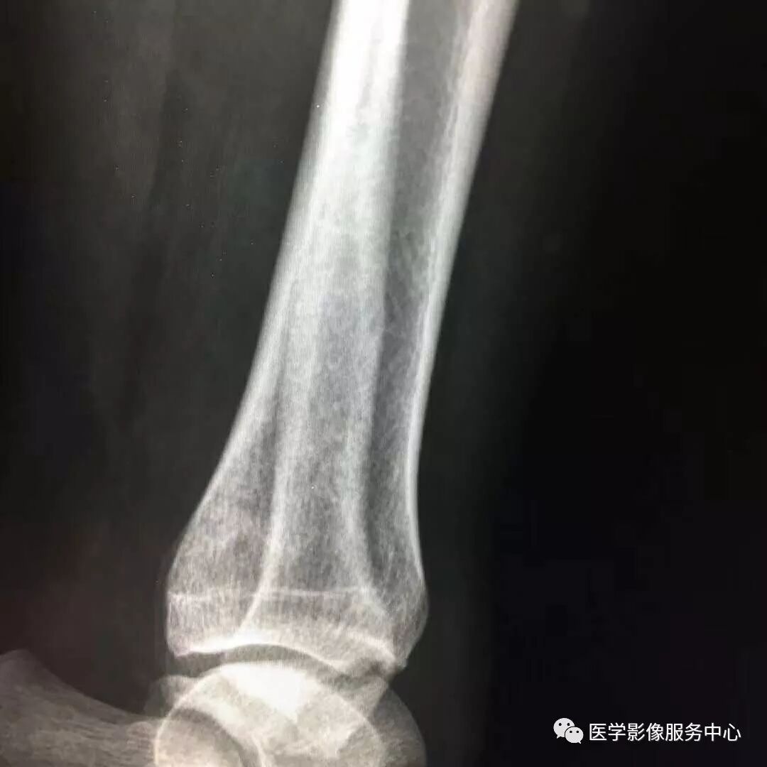 一例看不见骨折透亮线的骨折，新手估计会漏诊