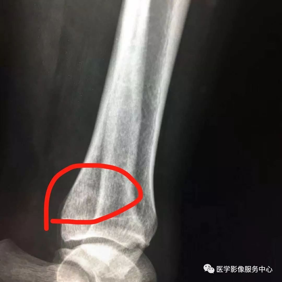 一例看不见骨折透亮线的骨折，新手估计会漏诊