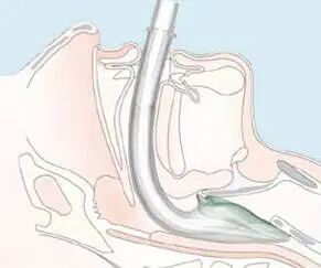 为什么要用喉罩你知道如何合理正确使用喉罩吗？_https://www.jmylbn.com_新闻资讯_第3张