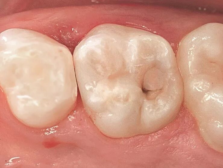 儿童龋齿的充填治疗