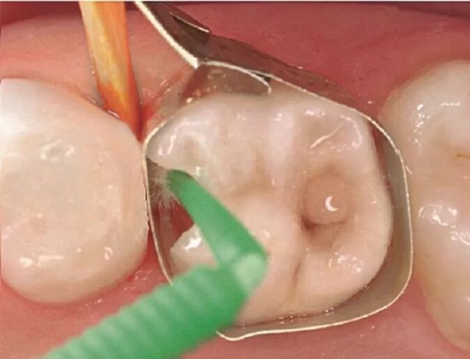 儿童龋齿的充填治疗