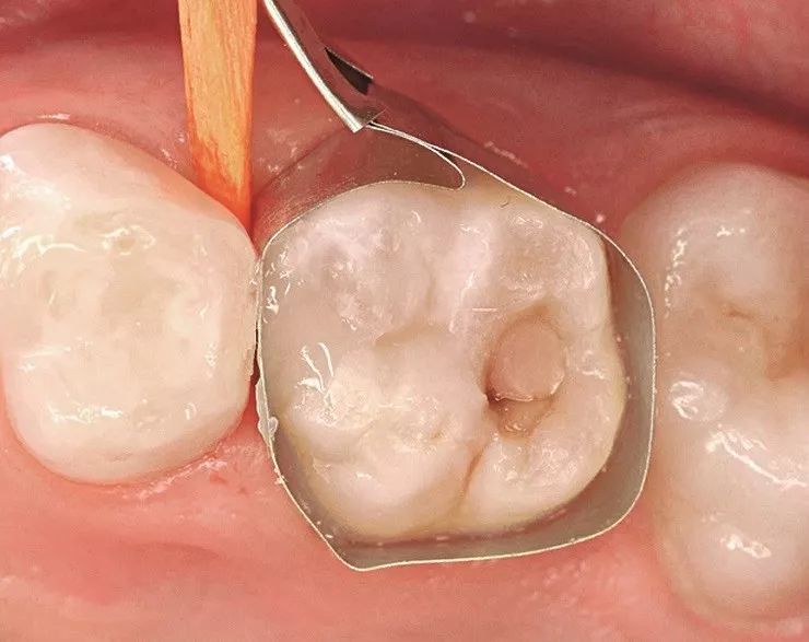 儿童龋齿的充填治疗