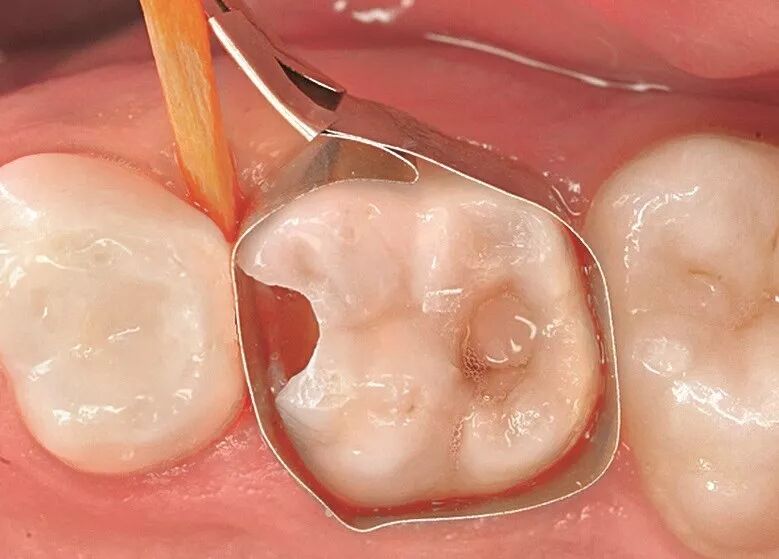 儿童龋齿的充填治疗