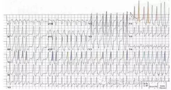 心电监护怎么看图【PLUS版】心电图危急值识别及紧急处理，值得每个医生收藏！！！_https://www.jmylbn.com_新闻资讯_第15张