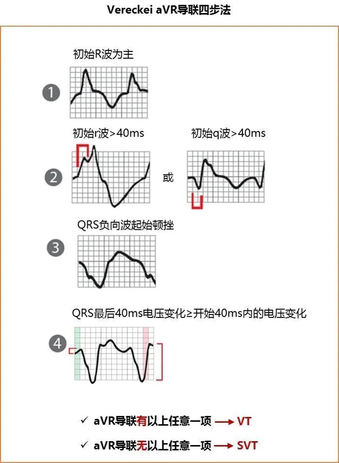 室速与室上速的快速鉴别方法